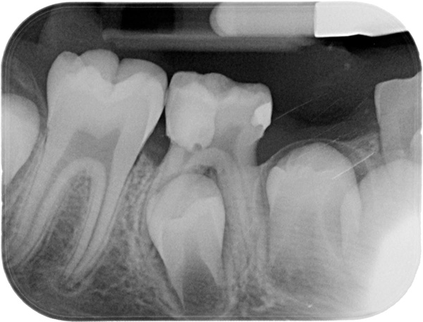 Mineralisierung von Geweben Das Rudiment eines bleibenden Zahns beginnt in den ersten Lebensmonaten eines Kindes.