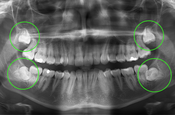 Na obrázku sú zvýraznené zuby múdrosti - je zrejmé, že spodné zuby nie sú najlepším spôsobom.