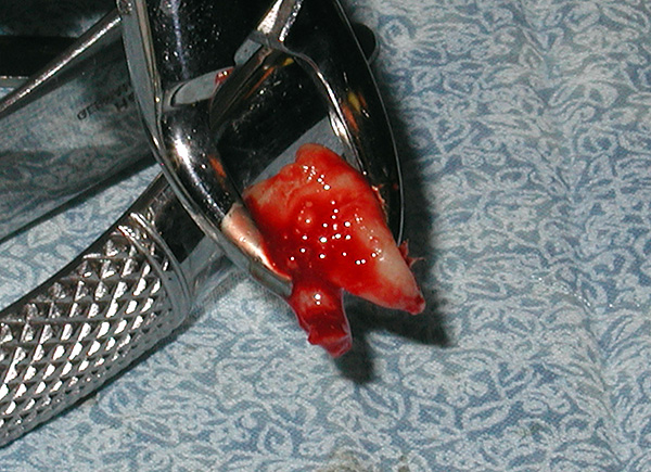 Bieži vien ar ortodontisko ārstēšanu ir jānoņem astotnieki.