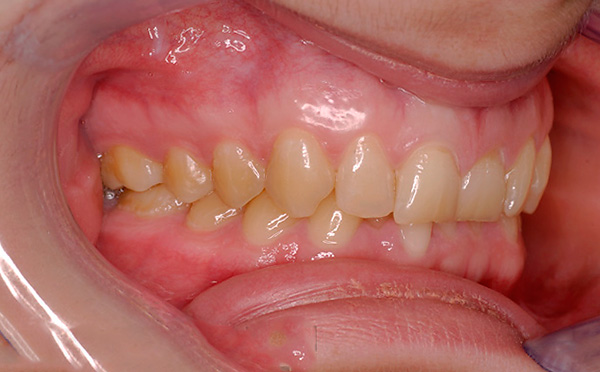 Dengan gigitan prognathic, incisors yang lebih rendah sering mencederakan membran mukus di langit.