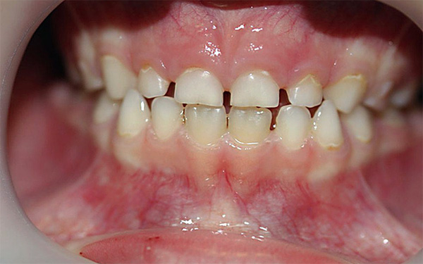 На определен етап млечните зъби могат да претърпят значителна физиологична абразия.