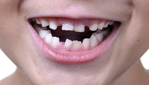 خلال فترة تغيير أسنان الحليب لدغة دائمة ، قد يكون الطفل بعيدًا عن المثالية.
