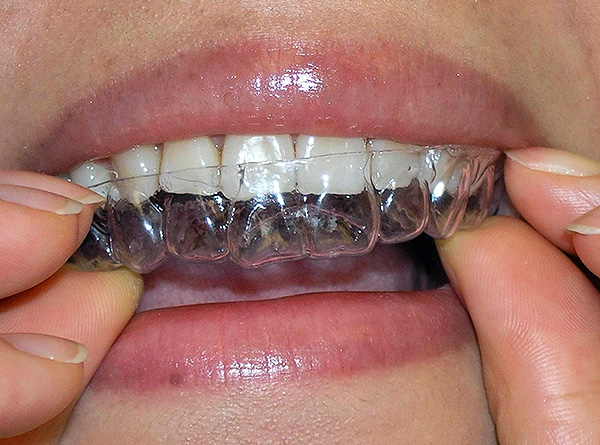Przezroczyste ochraniacze na usta (elinery) pozwalają skutecznie skorygować zgryz bez konieczności korzystania z systemów wsporników.