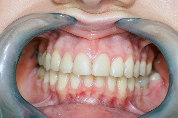 Such a bite is considered a kind of standard that orthodontists seek in the treatment of patients.