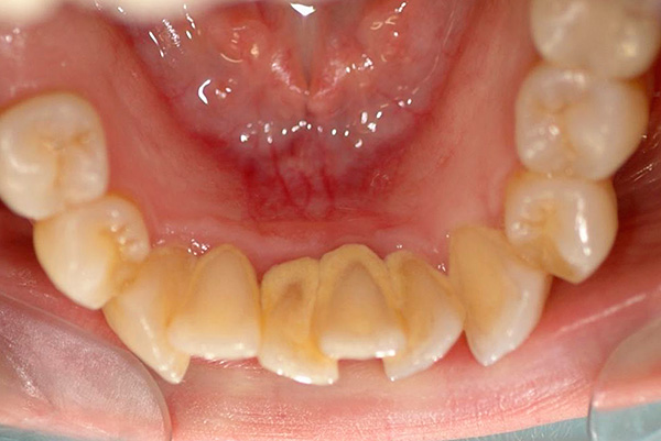 Vytlačování nižších řezáků způsobuje problémy s jejich hygienou a podporuje tvorbu zubního kamene.
