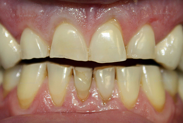 Malocclusion často vedie k silnému oderu jednotlivých zubov.