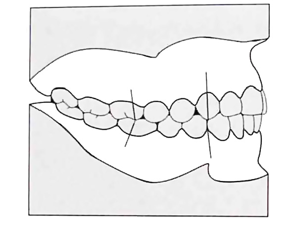 Angle ng pagsasara ng dentition I