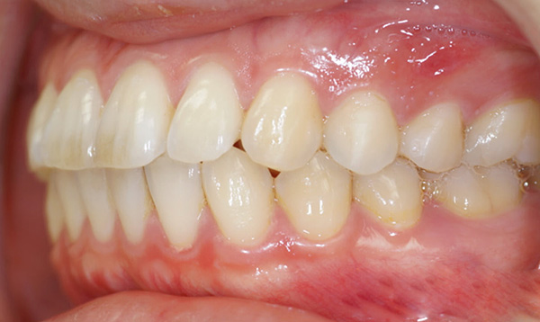 Με διπρογναθικό δάγκωμα, τα άνω και κάτω εμπρόσθια δόντια κλίνουν προς τα εμπρός.
