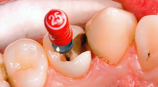 Să încercăm să ne dăm seama de ce după tratarea pulpitei, un dinte poate răni încă mult timp ...