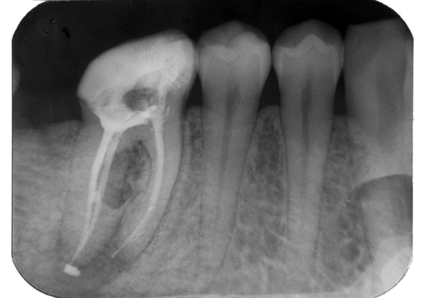 La sortie du matériau de remplissage au-delà de l'apex de la racine de la dent peut entraîner des douleurs prolongées après le remplissage.