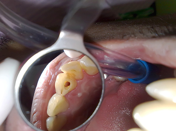En alguns casos, el dolor quan es mossega una dent és tan fort que és gairebé impossible de mastegar per un costat de la mandíbula.