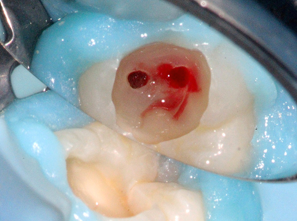 Treatment of tooth canals is a rather traumatic procedure.