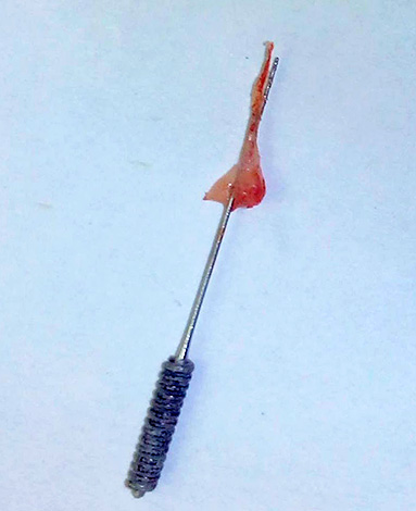 La photographie montre la pulpe retirée du canal dentaire.
