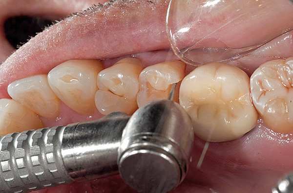 Apabila merawat gigi dengan gerudi, ada pemanasan kuat gigi enamel, dentin, serta boron berputar itu sendiri.