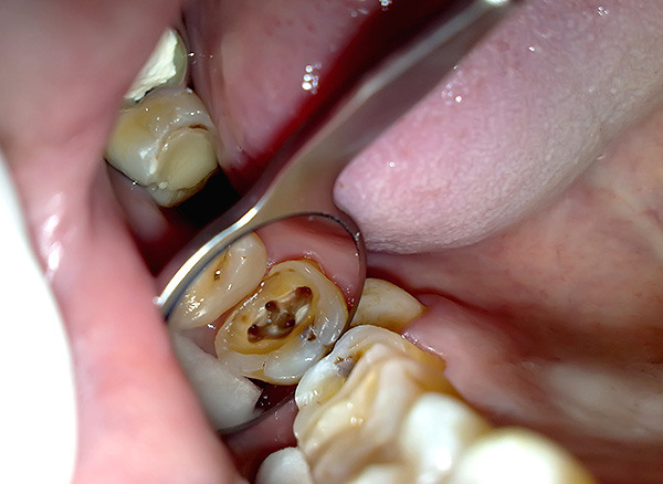 Așa arată gura canalelor radiculare ale dintelui de mestecat.