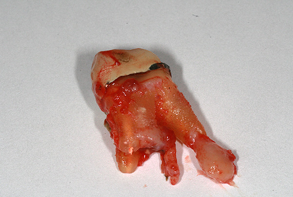 Kesalahan dalam rawatan pulpitis boleh menyebabkan pembentukan sista pada akar gigi.