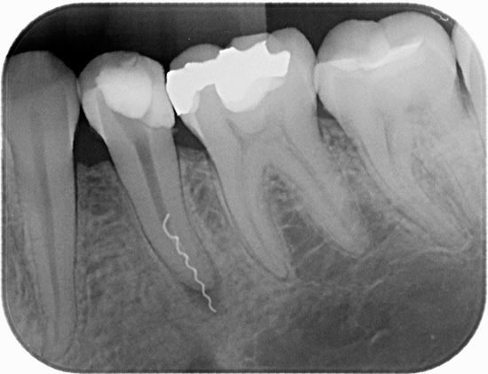 Šaknies kanale užstrigęs danties instrumento gabalas yra aiškiai matomas rentgeno nuotraukoje.