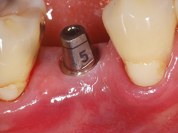 La probabilidad de rechazo del implante con buena higiene bucal es muy baja.