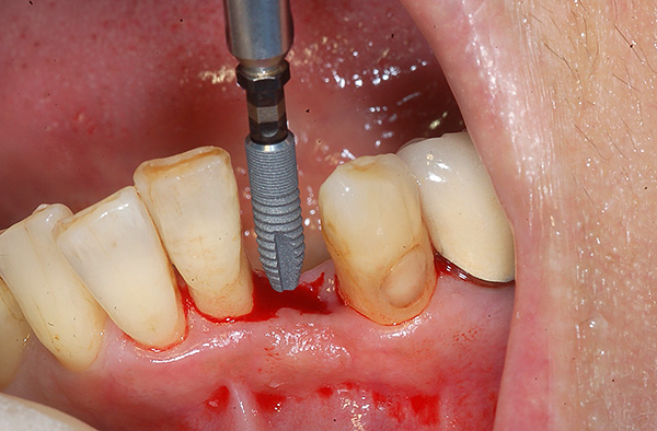 Снимката показва пример за инсталиране на имплантанта Astra Tech на долната челюст.