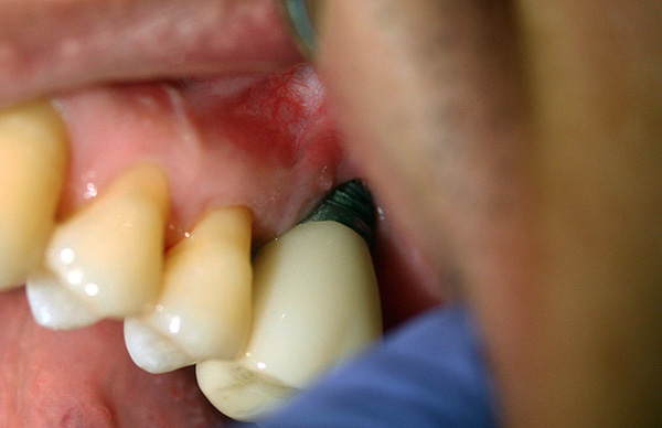Zo kan implantaatblootstelling door verzakking van het tandvlees er in de praktijk uitzien.