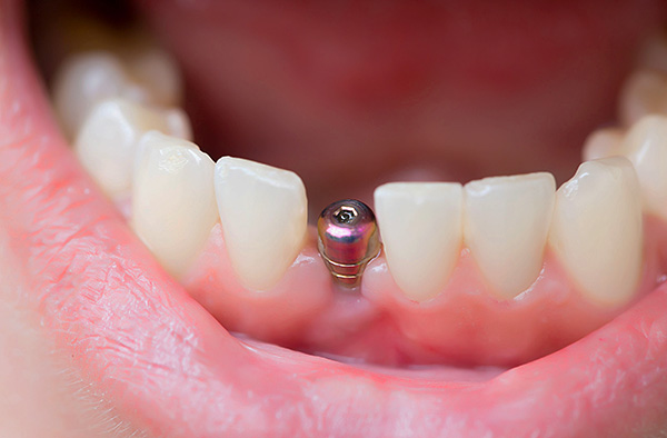 We study what is included in the installation of a turnkey tooth implant, and for which you will have to pay extra separately ...
