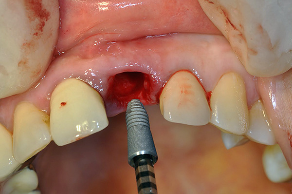 Príklad inštalácie implantátu Astra Tech