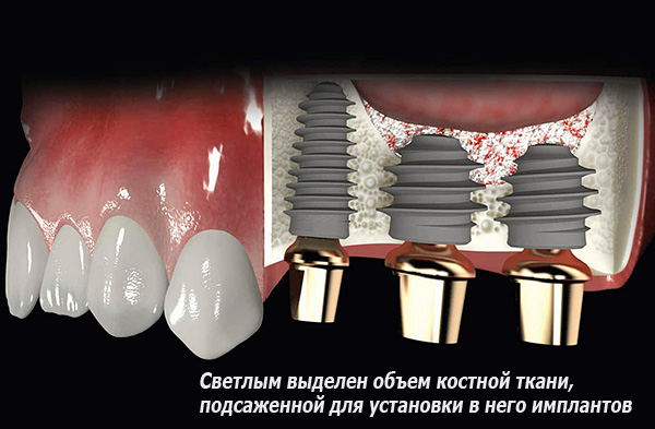 การยกไซนัสช่วยให้คุณสามารถคืนค่าปริมาณเนื้อเยื่อกระดูกที่เพียงพอสำหรับการติดตั้งรากฟันเทียมในภายหลัง