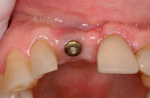 De prijs kan ook worden beïnvloed door het abutment en de kroon die worden gebruikt in de laatste fase van protheses (de kauwgumvormer wordt op de foto getoond).