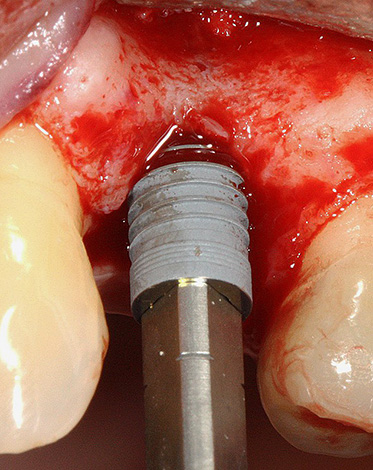 Vložení implantátu do právě odstraněné jamky zubu.