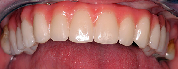 Dentadura completa de la mandíbula superior montada en 4 implantes.