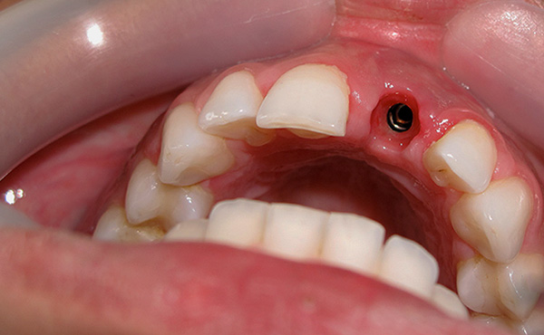 El preu indicat per a una implantació de dents en mà és mínim, però de fet pot augmentar significativament.