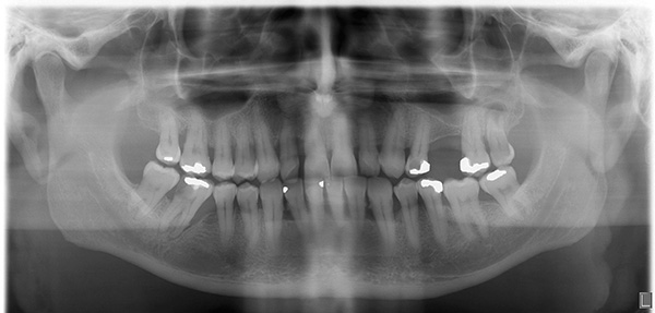 Ortopantomograma vă permite să evaluați starea dinților și a țesuturilor adiacente.