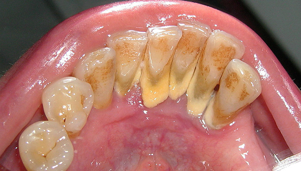 Prije izvođenja zubne implantacije važno je ukloniti sve žarišta nakupljanja bakterija u usnoj šupljini (uključujući uklanjanje zubnog kamena).