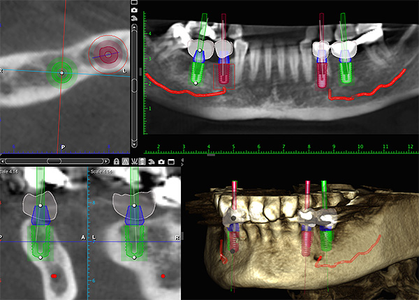 Modeling the location of future implants in the jaw on a computer.