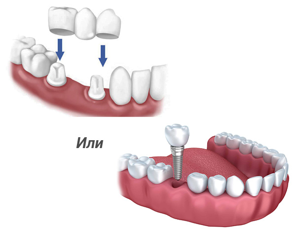 Izdomāsim, kas ir labāk - laika pārbaudīts zobu tilts vai mūsdienīga protezēšana uz zobu implantiem ...