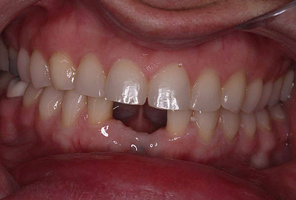 În situația prezentată în fotografie, cei doi dinți inferiori frontali ar putea fi restabiliți folosind o punte convențională.