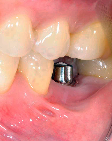 Žvýkací zubní implantát.