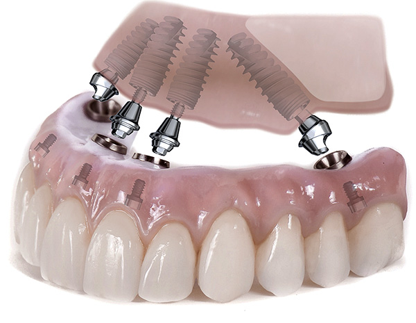 Visų implantų viršutinio žandikaulio dantų protezavimo pavyzdys naudojant „All-on-4“ technologiją.