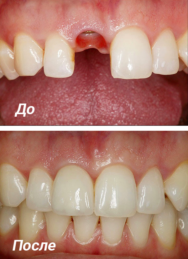 תותבות שיניים על גבי שתלים מאפשרות לך להשיג את האסתטיקה הגבוהה ביותר של התוצאה הסופית.