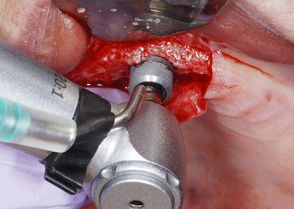 A desvantagem do implante dentário é um período de reabilitação bastante longo após a cirurgia.