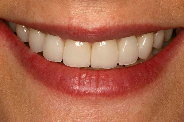 ในกรณีส่วนใหญ่การใช้รากฟันเทียมนั้นมีข้อดีมากกว่าการติดตั้งสะพาน