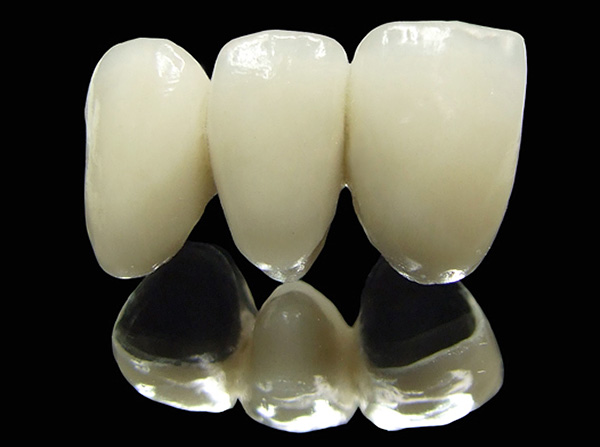 Pont en céramique-métal pour les prothèses de l'une des dents de devant.