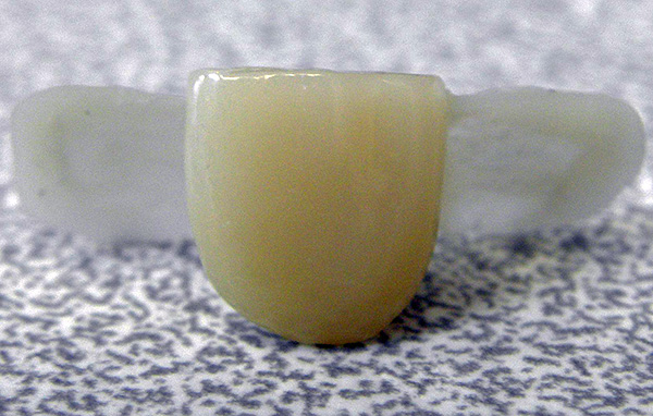 O punte adezivă este atașată de dinții adiacenți prin lipirea de plăci mici pe ele.