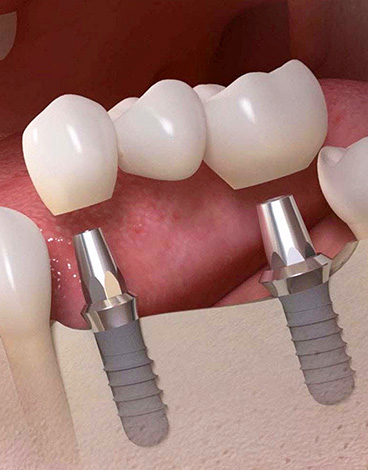 A ponte também pode ser instalada em implantes dentários ...