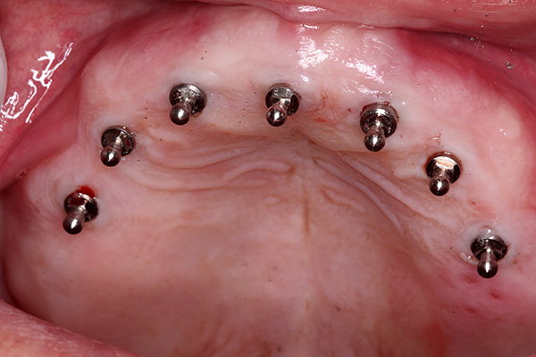 دعونا نرى ما هي مزايا استخدام غرسات صغيرة لأطراف صناعية للأسنان ...