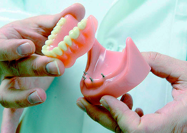 I mini impianti consentono di fissare in modo sicuro la protesi nella cavità orale e non aver paura che cada durante una conversazione.