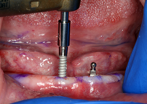 A mini implantátumok elhelyezése az alsó állkapocson