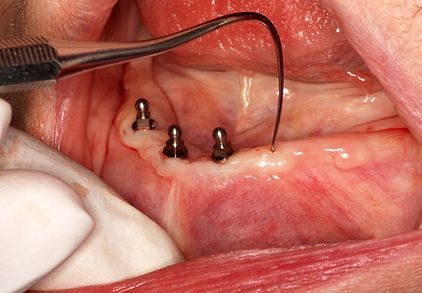 Instalarea mini-implanturilor este mai puțin traumatică decât instalarea implanturilor clasice.